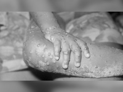 What is monkeypox and how do you catch it?