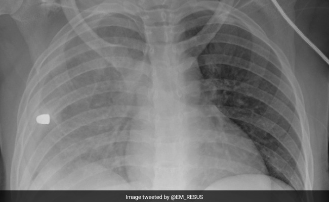 This X-Ray Scan Shows The Leading Cause Of Death In US Children